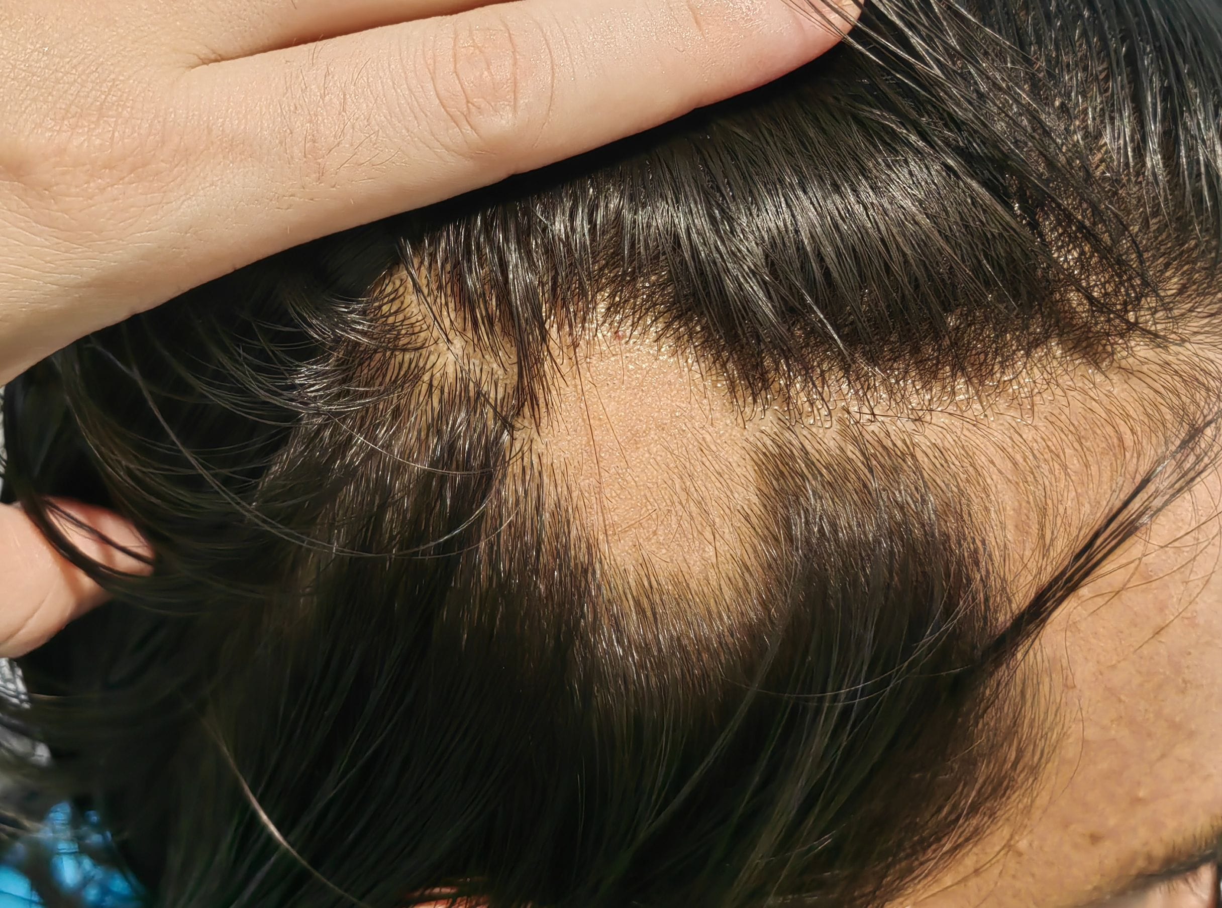 Alopecia Areata before Alopecia Areata before