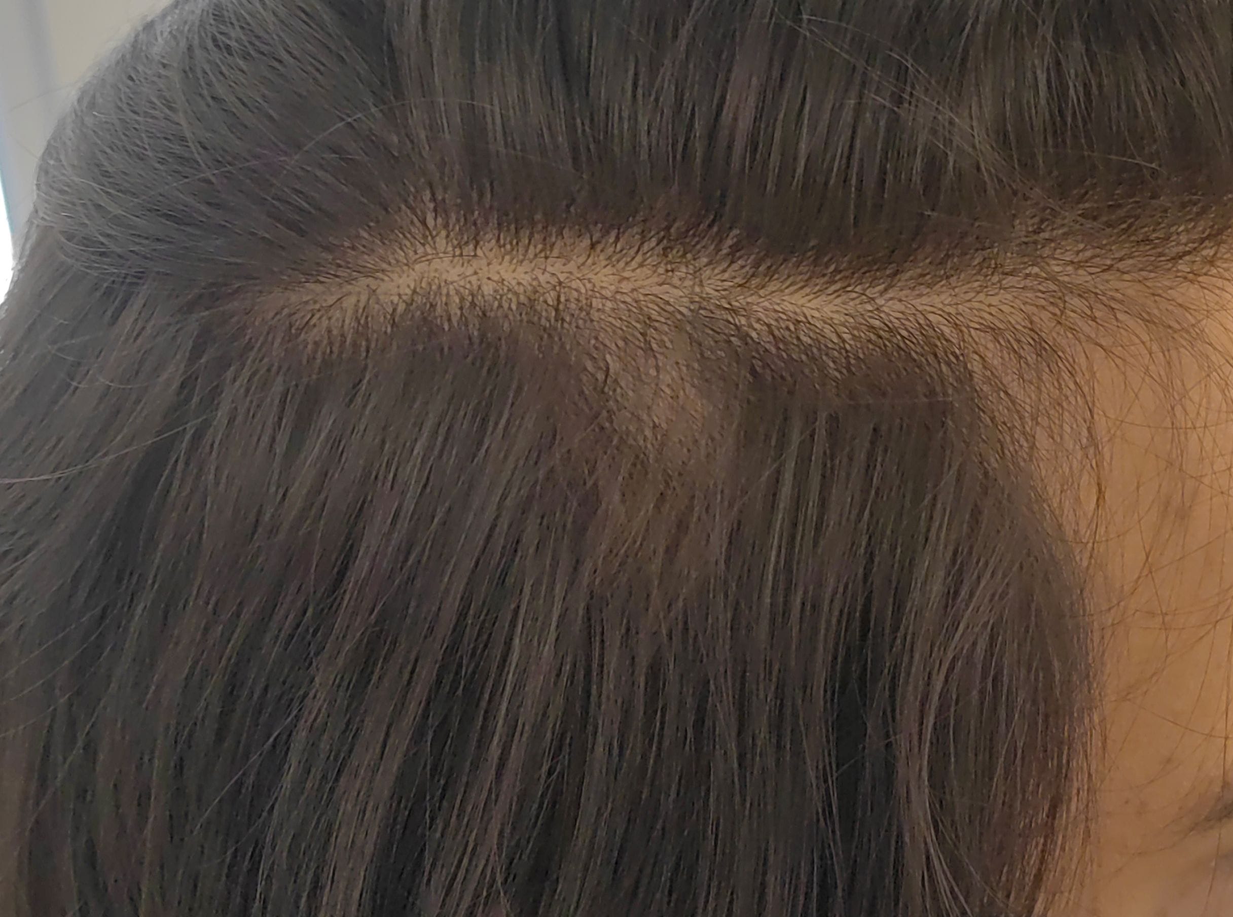 Alopecia Areata after Alopecia Areata after