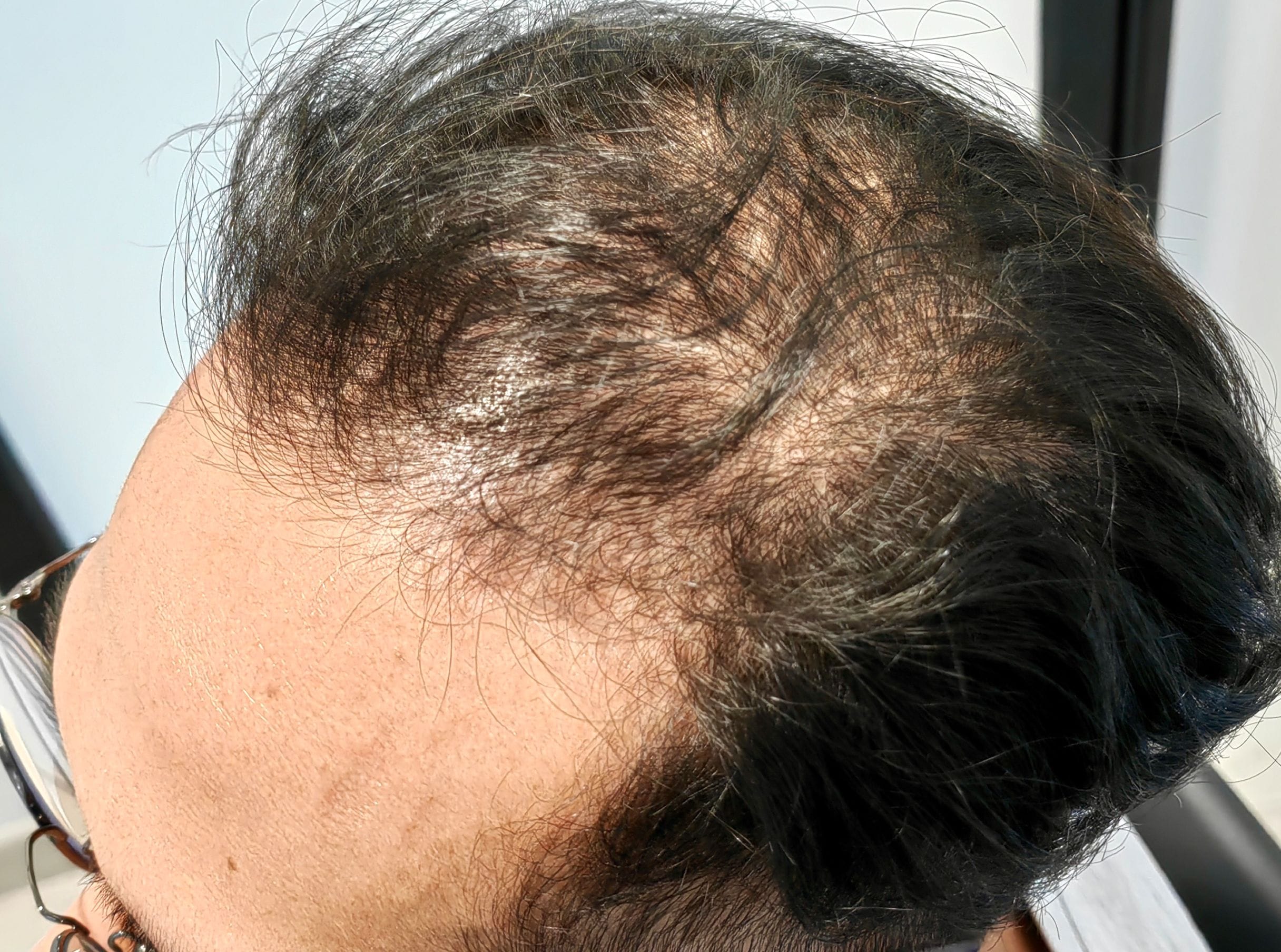 Men Hair Loss Before Men Hair Loss Before
