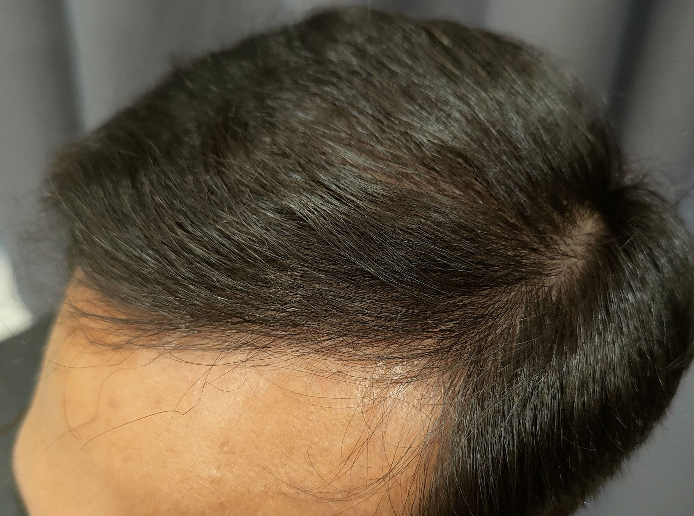 Men Hair Loss After Men Hair Loss After