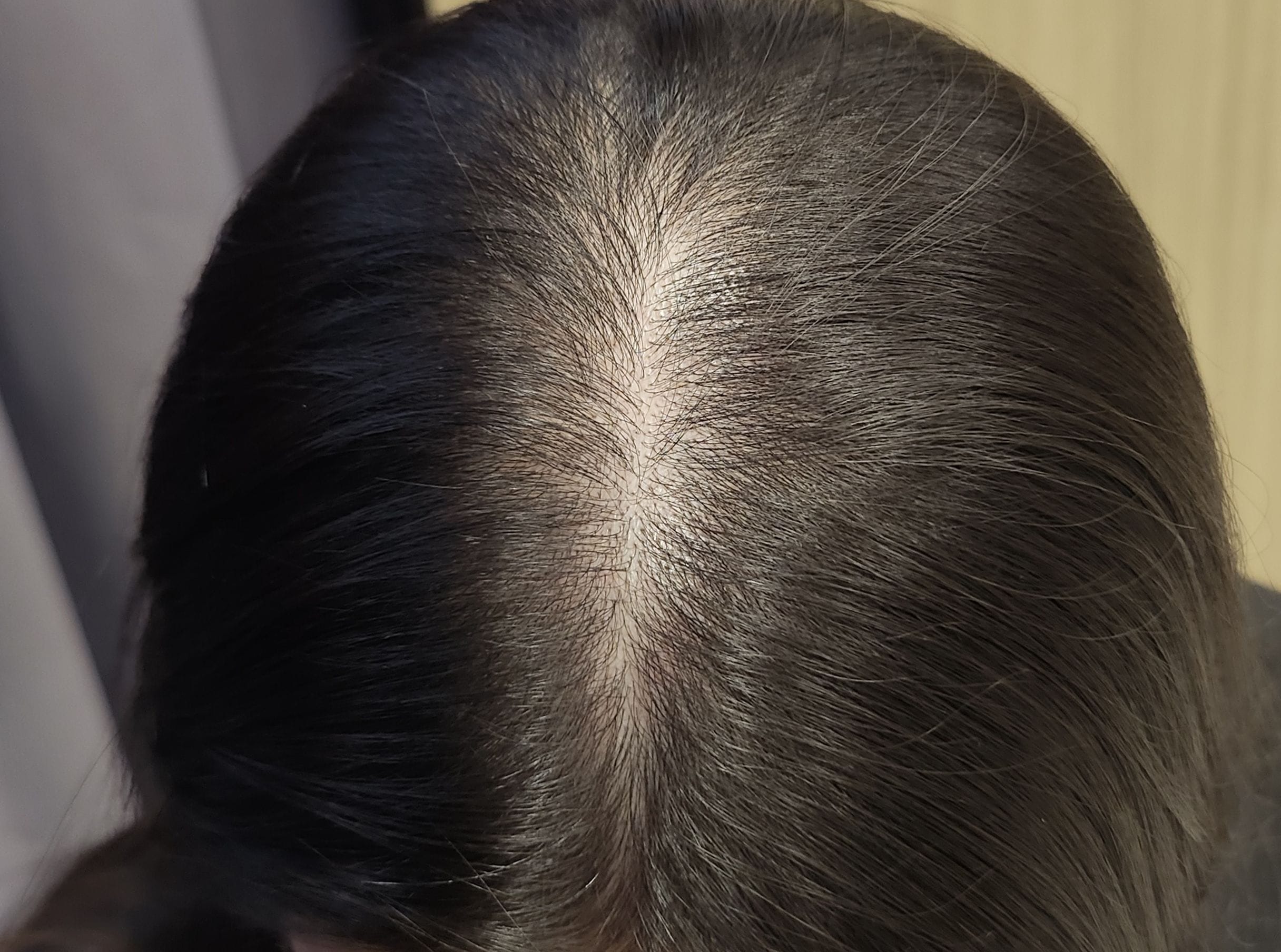 Oily scalp after Oily scalp after
