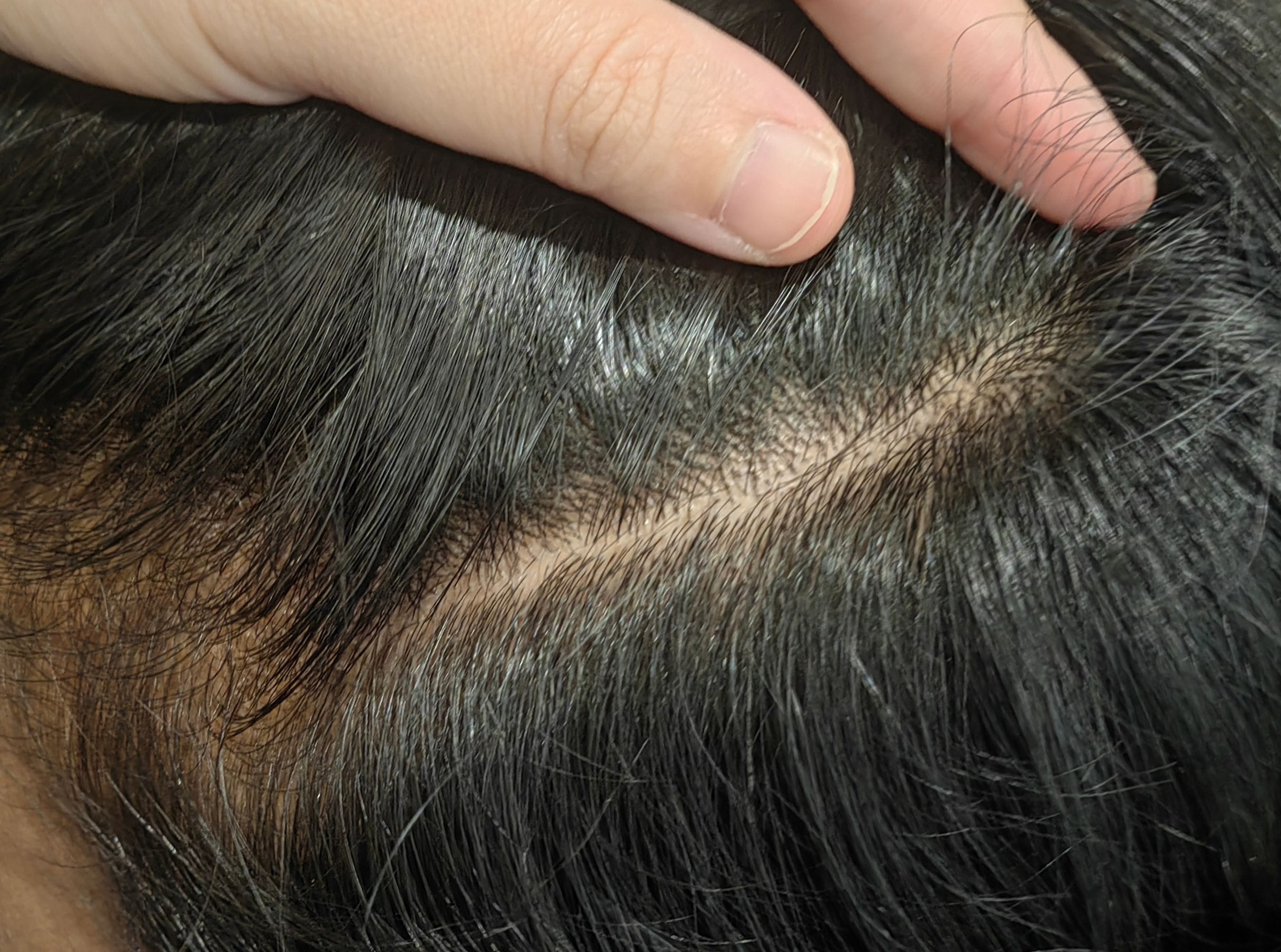 Psoriasis After Psoriasis After