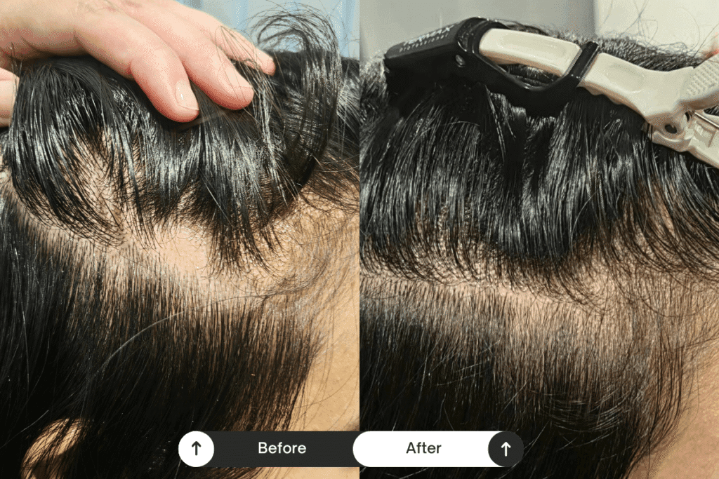 scalp treament before after 08