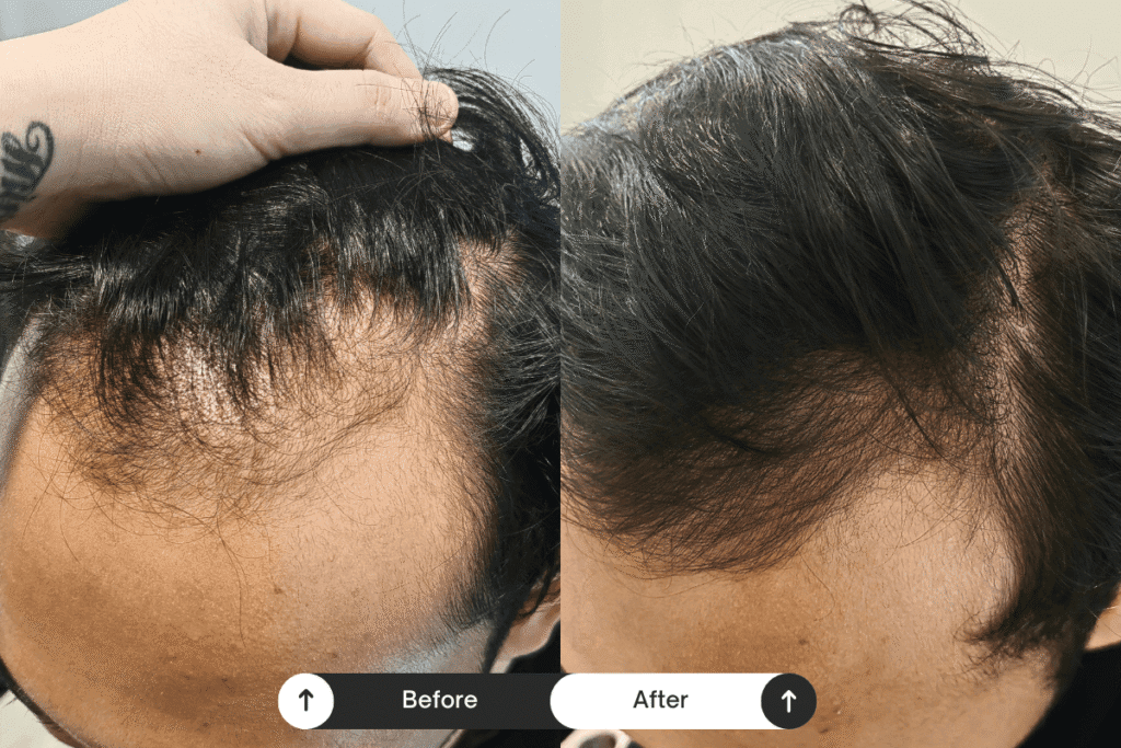 scalp treament before after 09