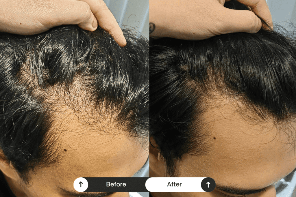 scalp treament before after 11